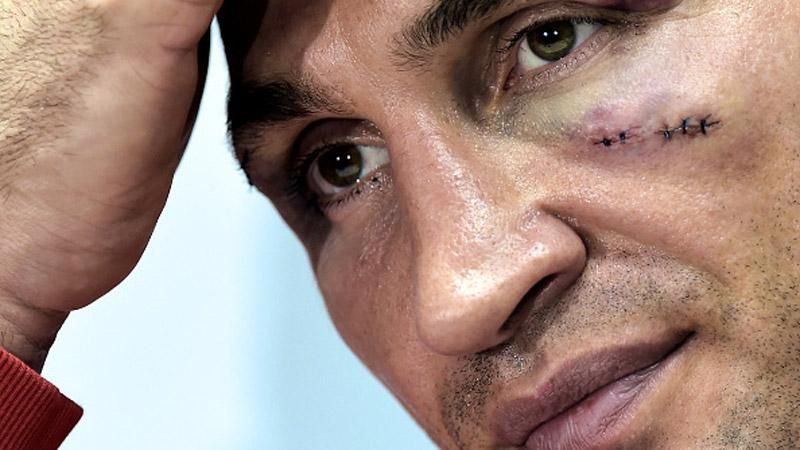 Кличко після бою з Ф'юрі показав синці та рани Кличко після бою з Ф'юрі показав синці та рани