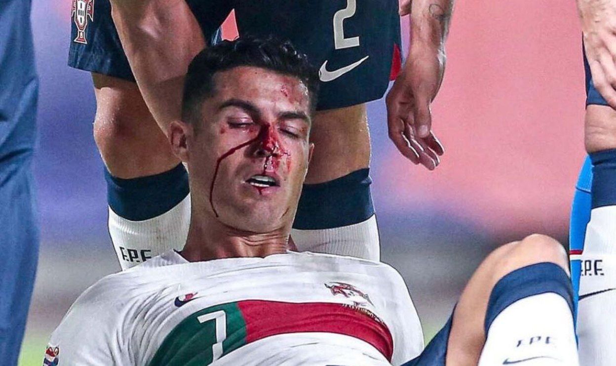 Кріштіану Роналду з розбитим носом Кріштіану Роналду з розбитим носом