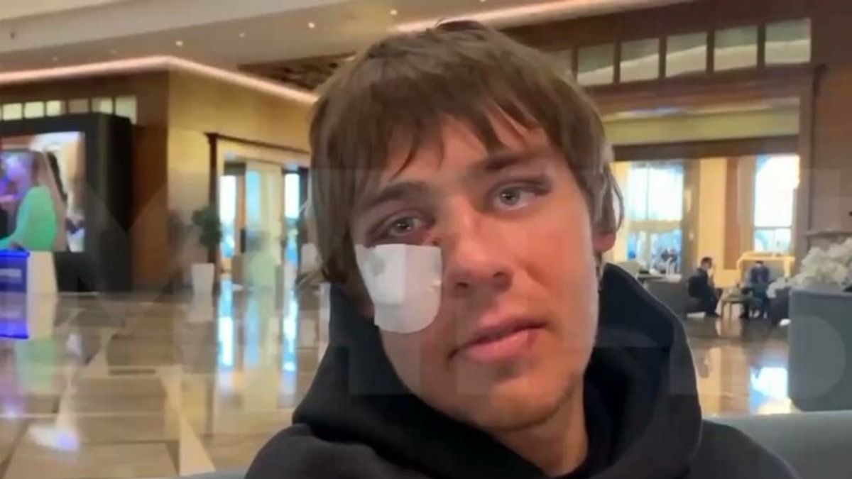 Артем Семейкін показав побите лице після бійки з Минаєм в Туреччині Артем Семейкін показав побите лице після бійки з Минаєм в Туреччині